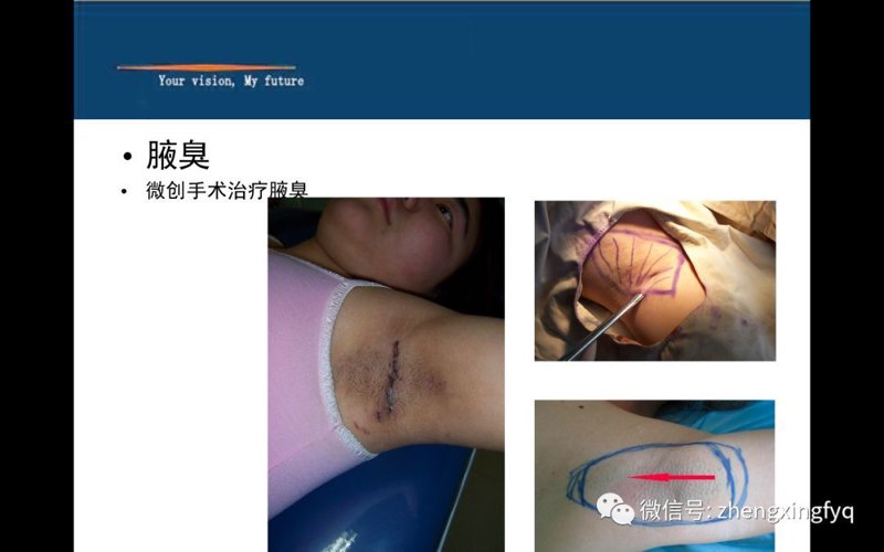 湖南附大腋臭专科